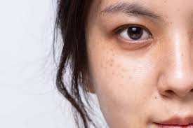 Liệu Trình Trị Nám Tàn Nhang Quận 2