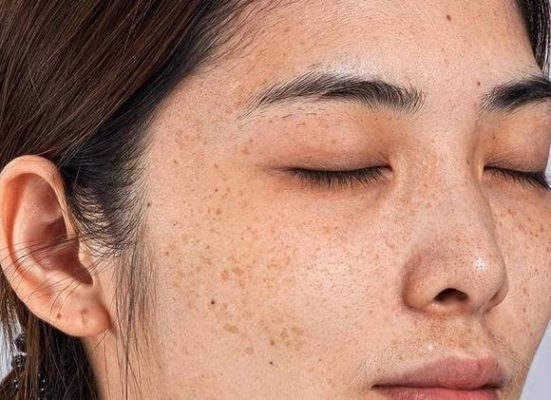 Liệu Trình Trị Nám Tàn Nhang Quận 2