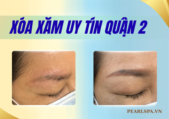 Spa Xóa Xăm Uy Tín Tại An Phú Quận 2