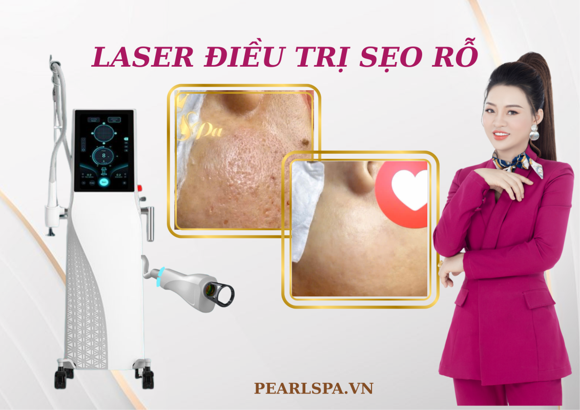Điều Trị Sẹo Rỗ Laser Tại Quận 2
