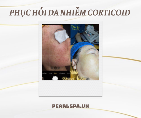 Phục Hồi Da Nhiễm Corticoid Tại Quận 2