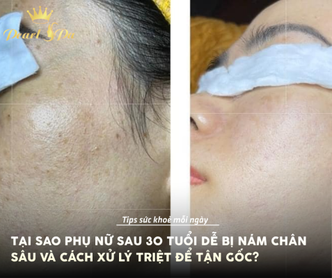 Trị Nám Quận 9